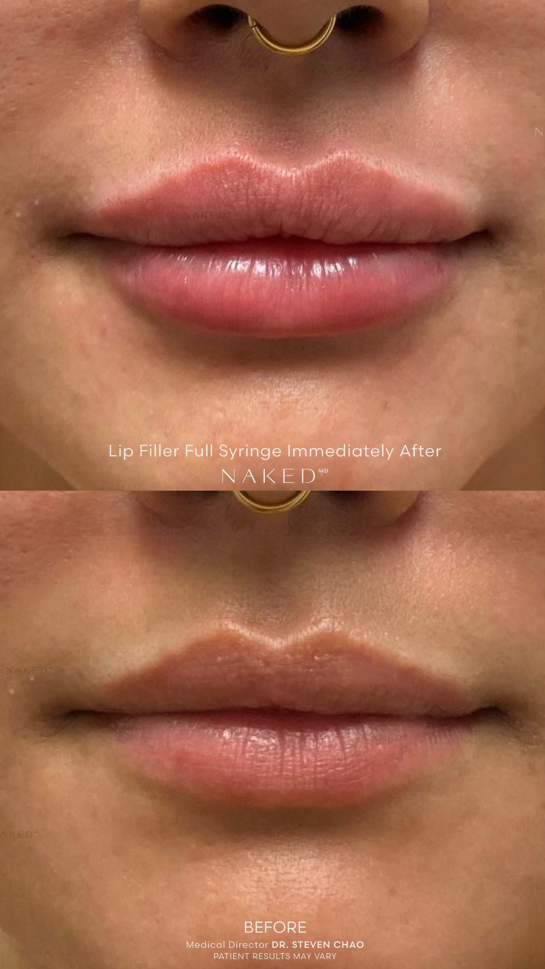 Naked Lips | Lip Filler