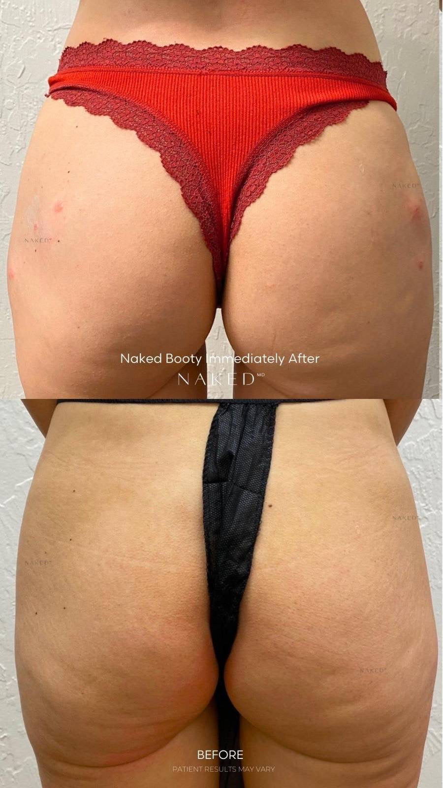 Naked Booty® | Non-Surgical Brazilian Butt Lift (BBL)