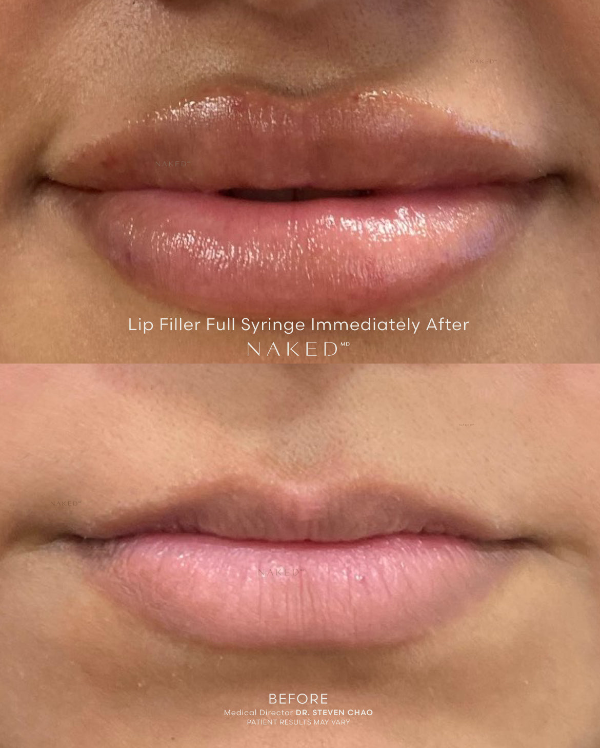 Naked Lips | Lip Filler