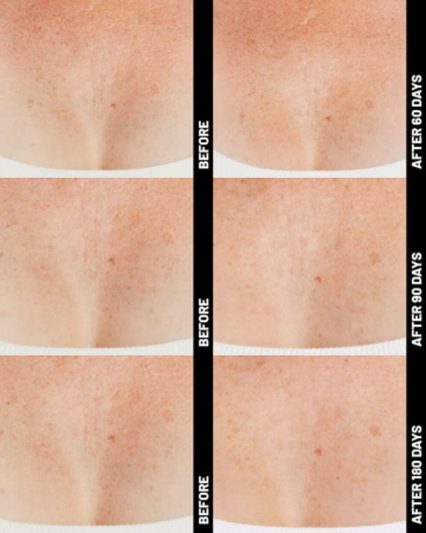 Ultherapy® | Non-Surgical Ultrasound Therapy