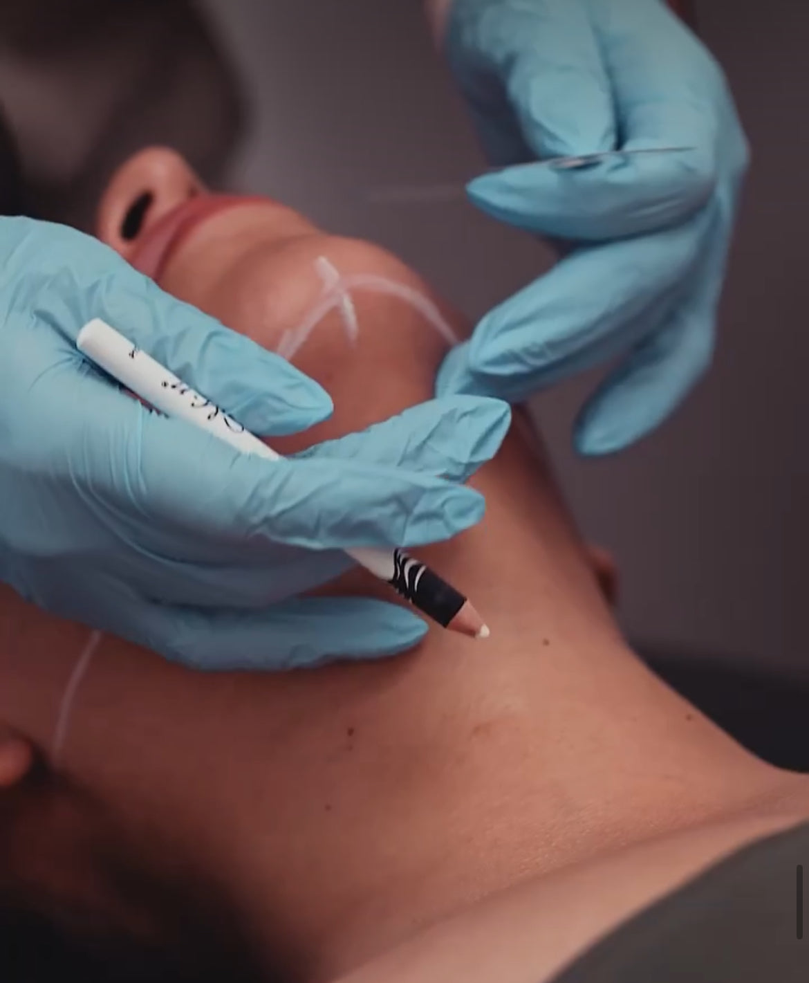 Ultherapy® Non Surgical Ultrasound Therapy