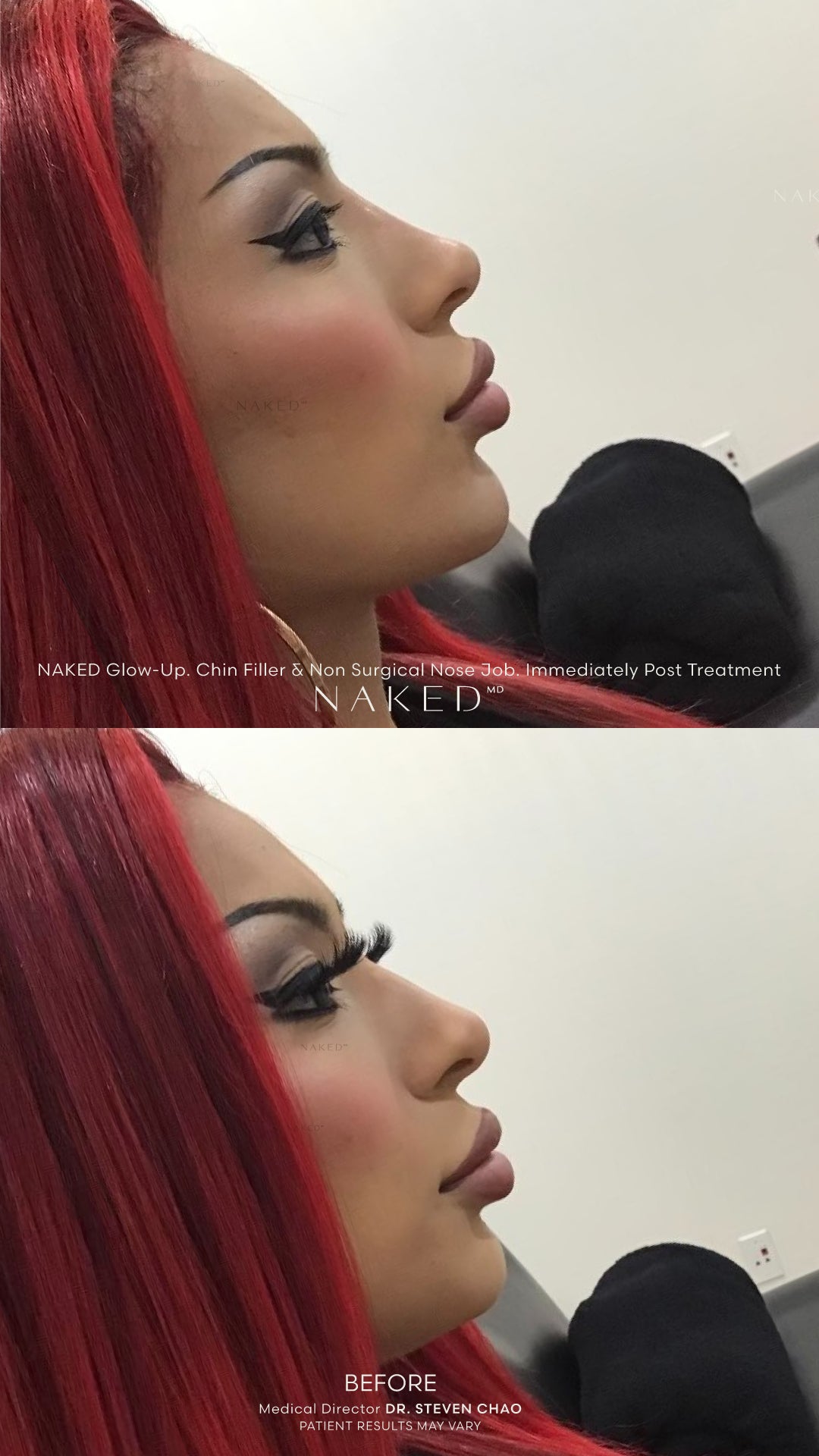 Naked Combo | Lips and Chin