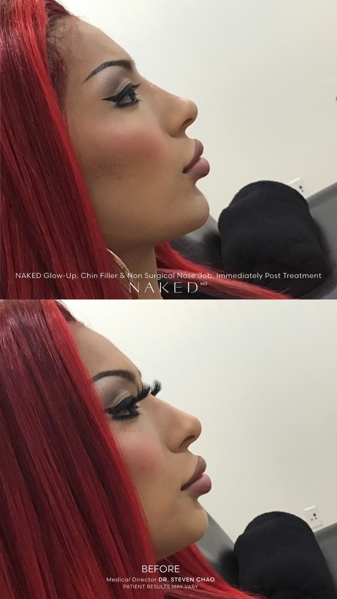 Naked Combo Lips | Chin
