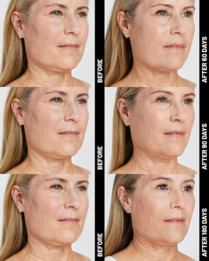 Ultherapy® | Non-Surgical Ultrasound Therapy