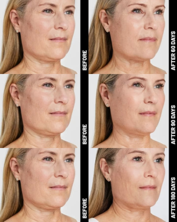 Ultherapy® | Non-Surgical Ultrasound Therapy