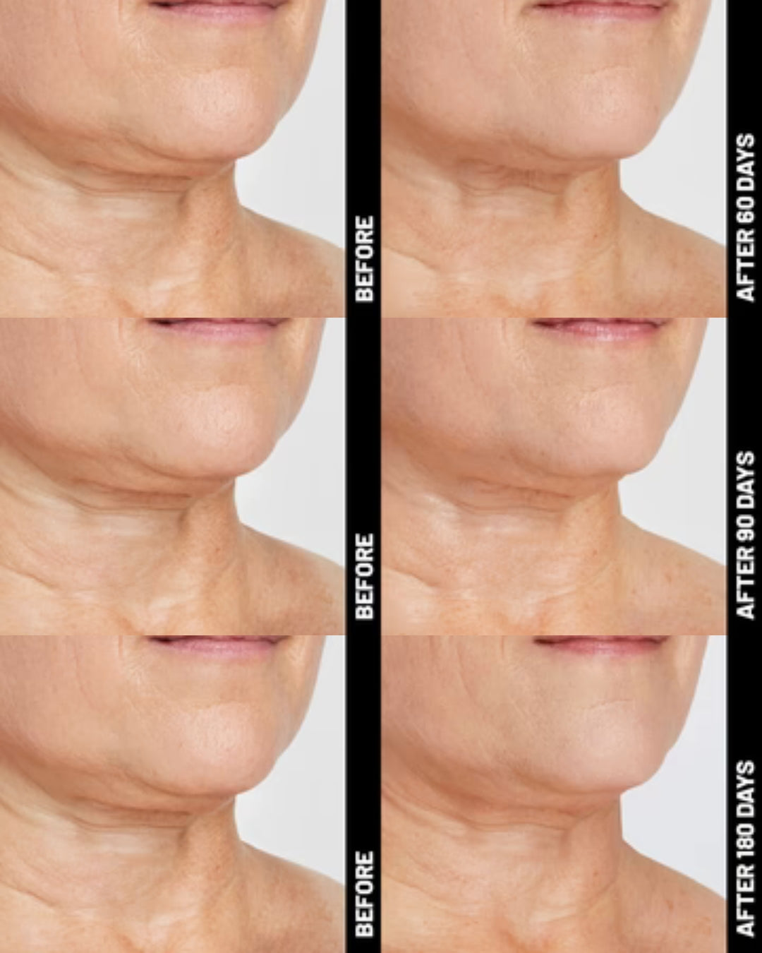 Ultherapy® | Non-Surgical Ultrasound Therapy
