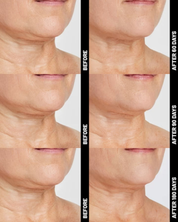 Ultherapy® | Non-Surgical Ultrasound Therapy
