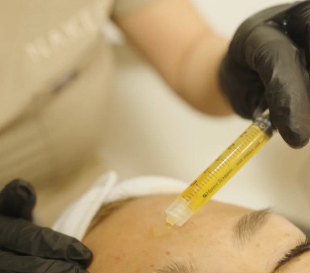 PRF (Platelet Rich Fibrin) Injection