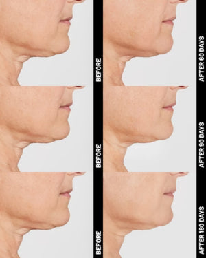 Ultherapy® | Non-Surgical Ultrasound Therapy