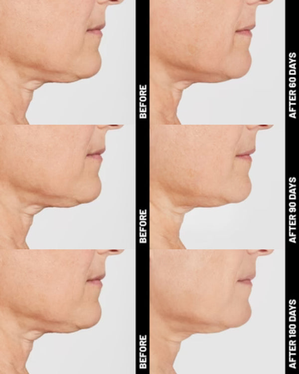 Ultherapy® | Non-Surgical Ultrasound Therapy