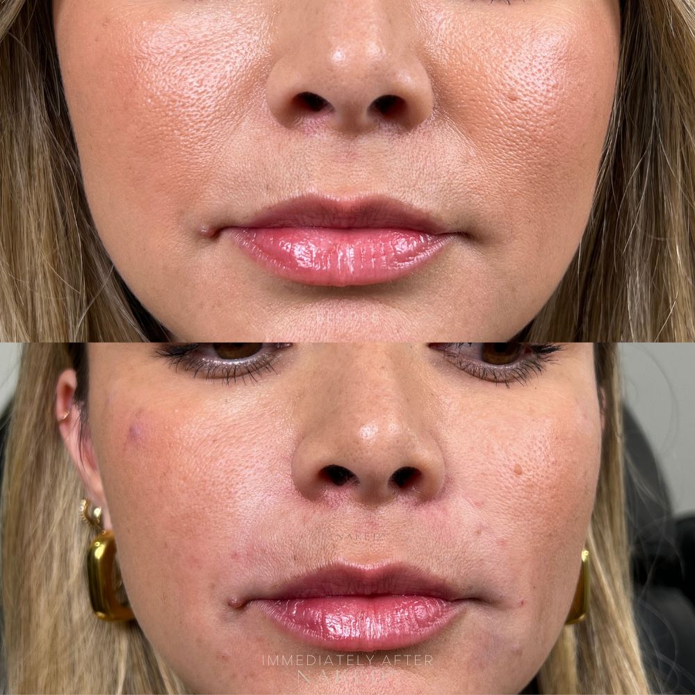 Smile Lines Filler | New Client Offer