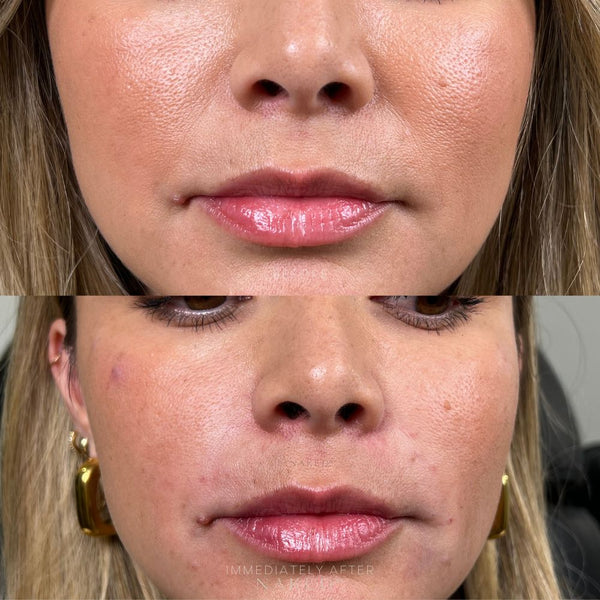 Smile Lines Filler | New Client Offer