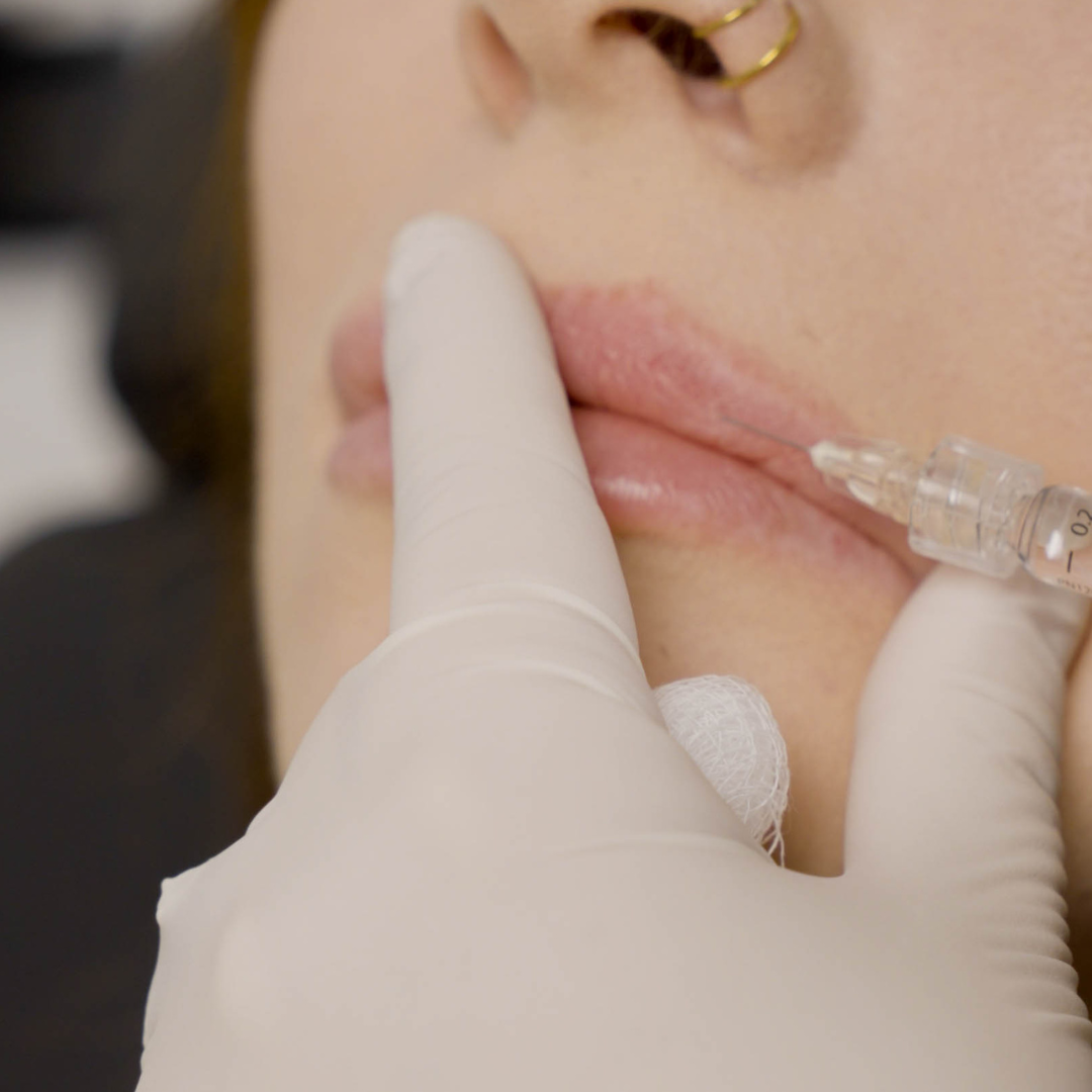 Lip Filler | 1st Time Patient Promo