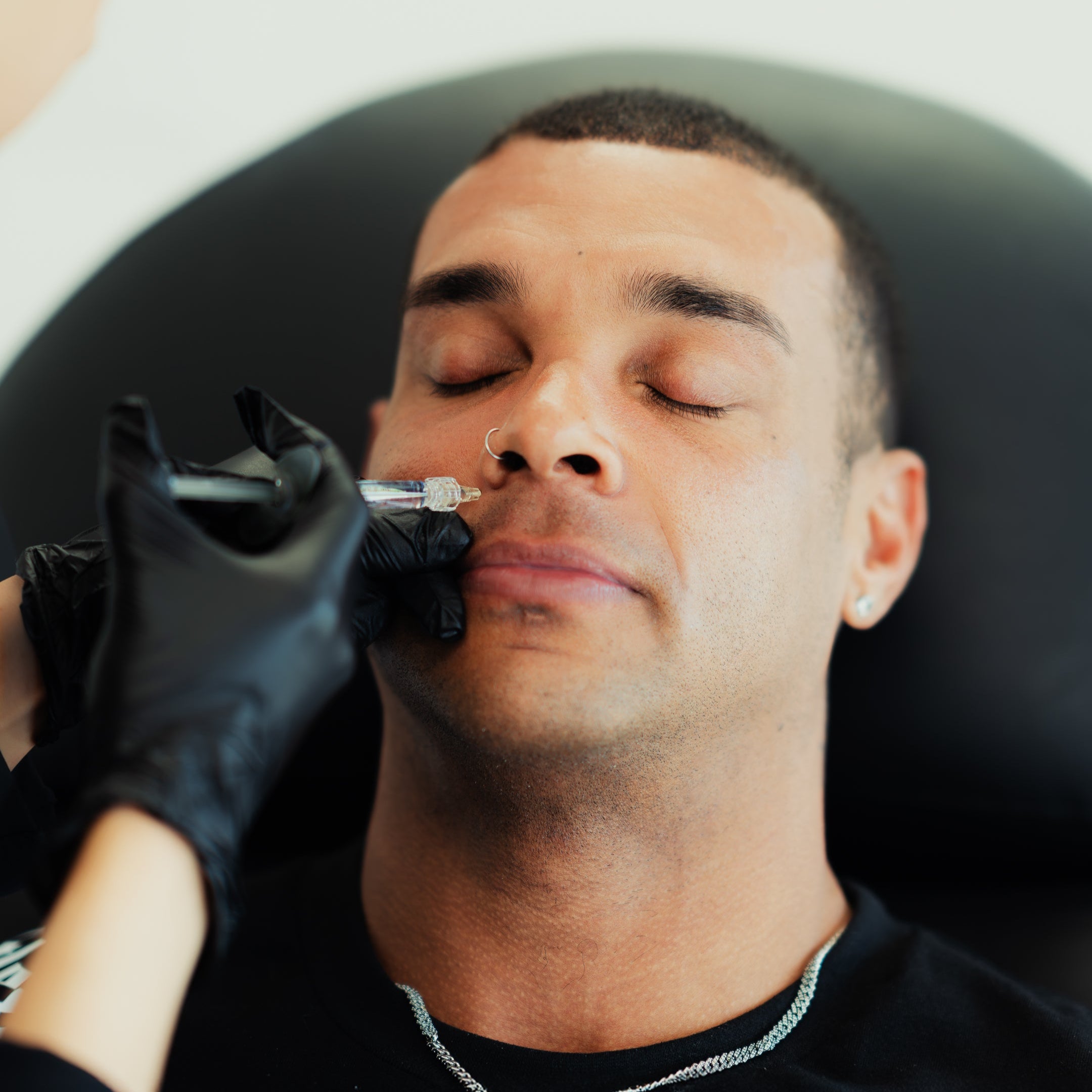 Line Filler Smile Line Fillers | Smooth Wrinkles & Refresh Your Look – NAKEDMD Medspa