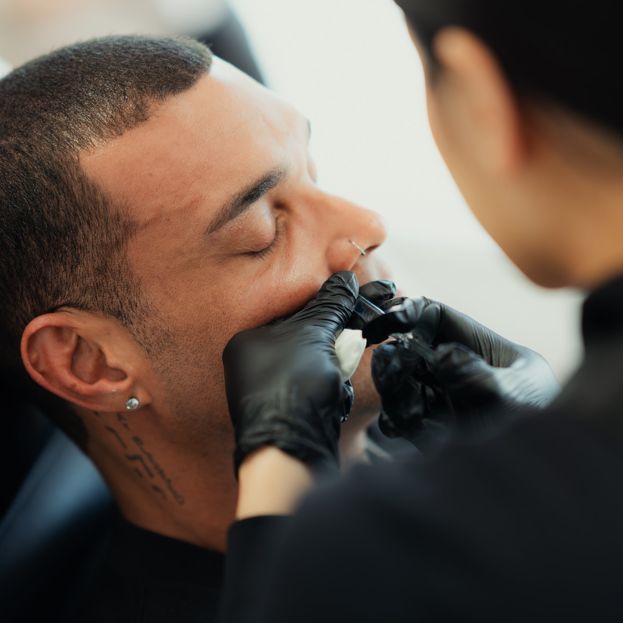 Line Filler Smile Line Fillers | Smooth Wrinkles & Refresh Your Look – NAKEDMD Medspa