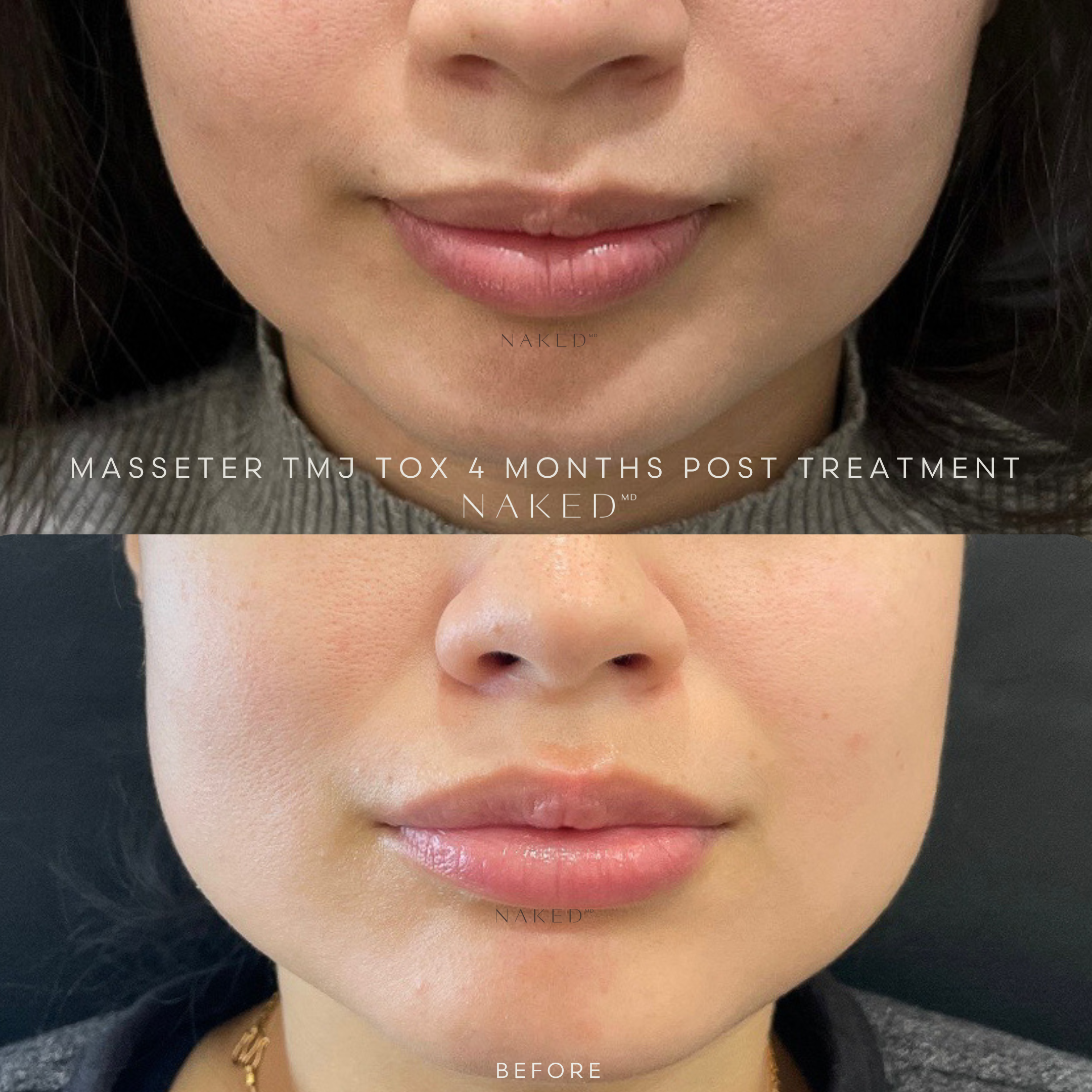 Masseter Reduction | TMJ