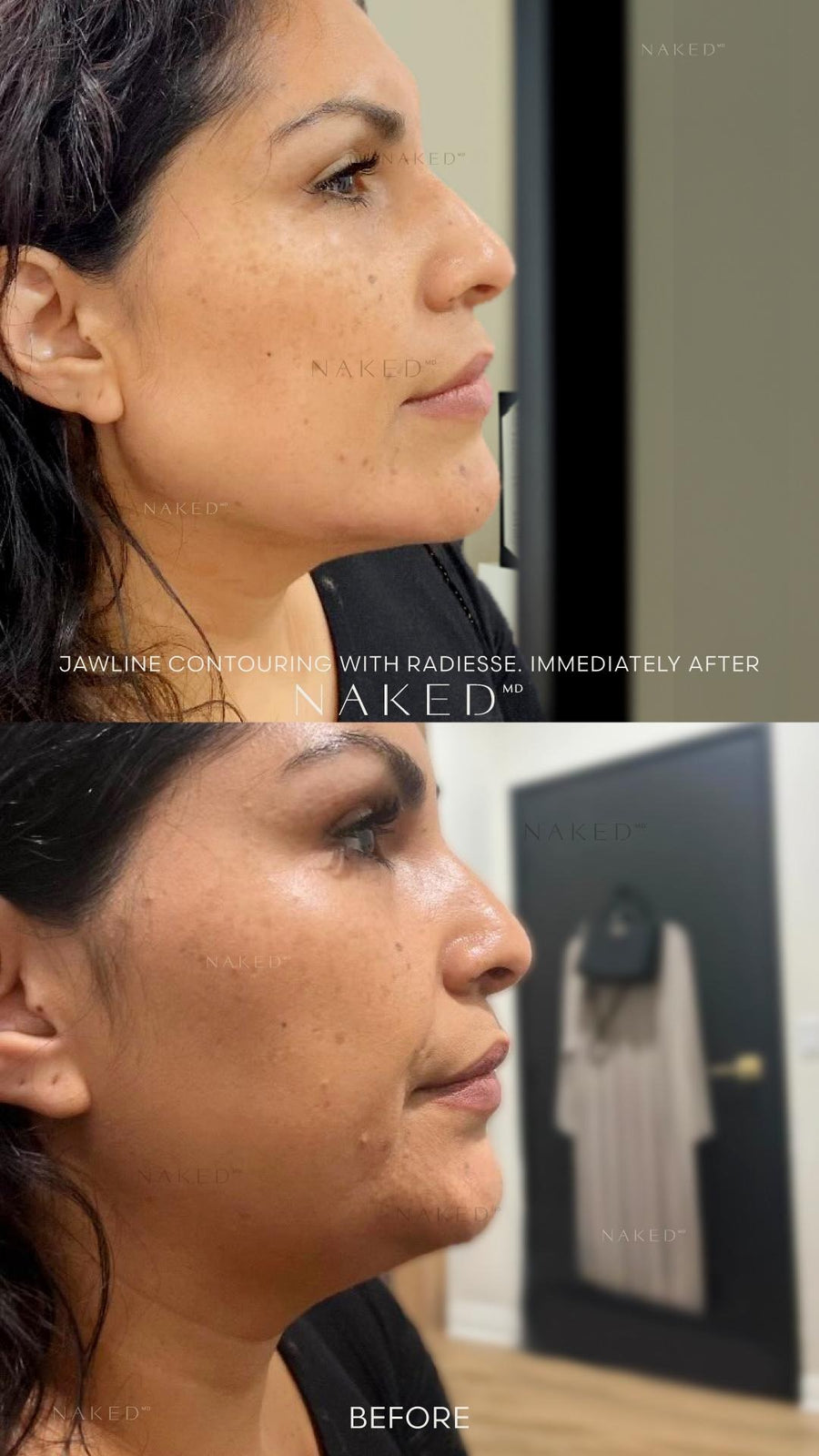 Radiesse Filler and Injections in California and Arizona – NAKEDMD Medspa