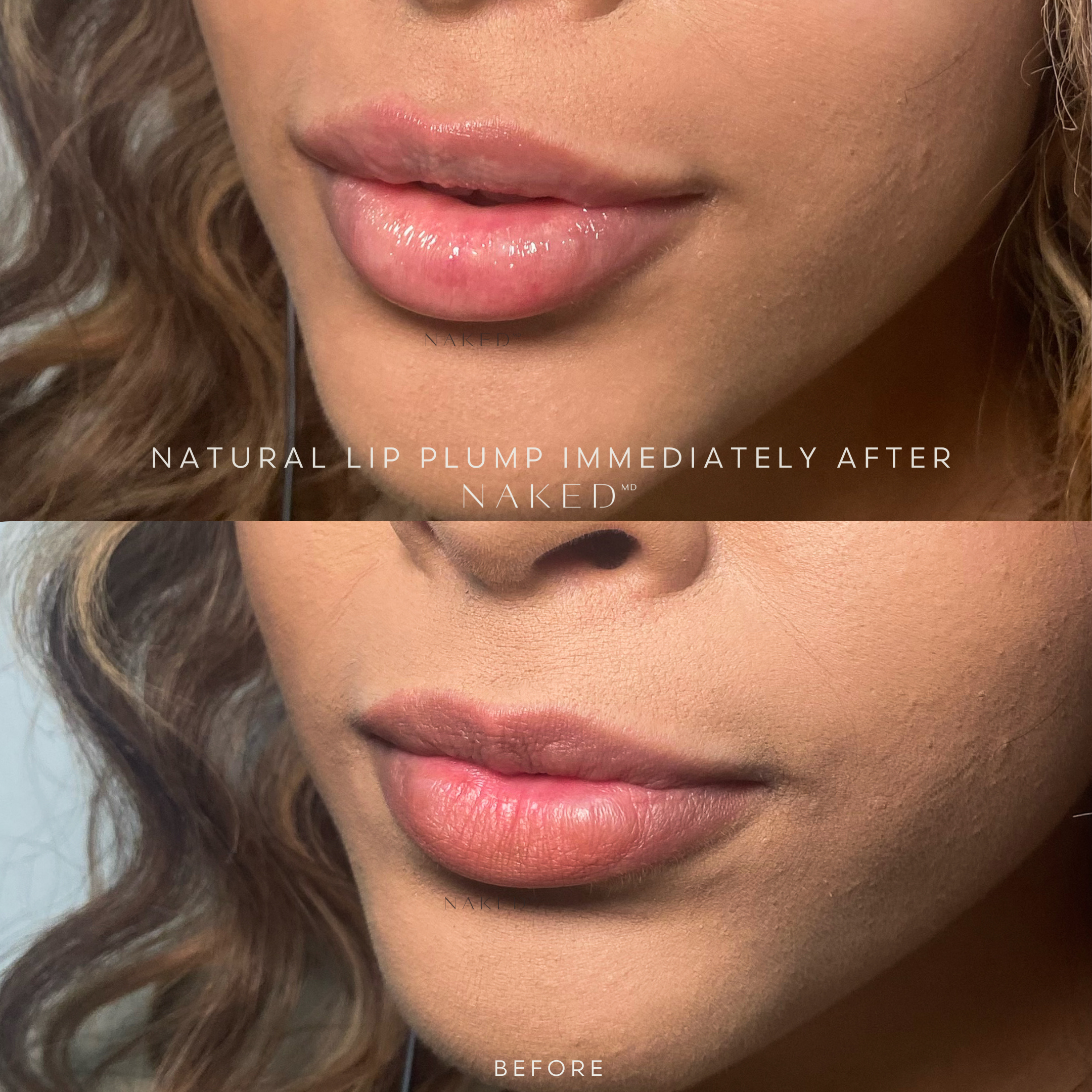 Naked Lips | Lip Filler