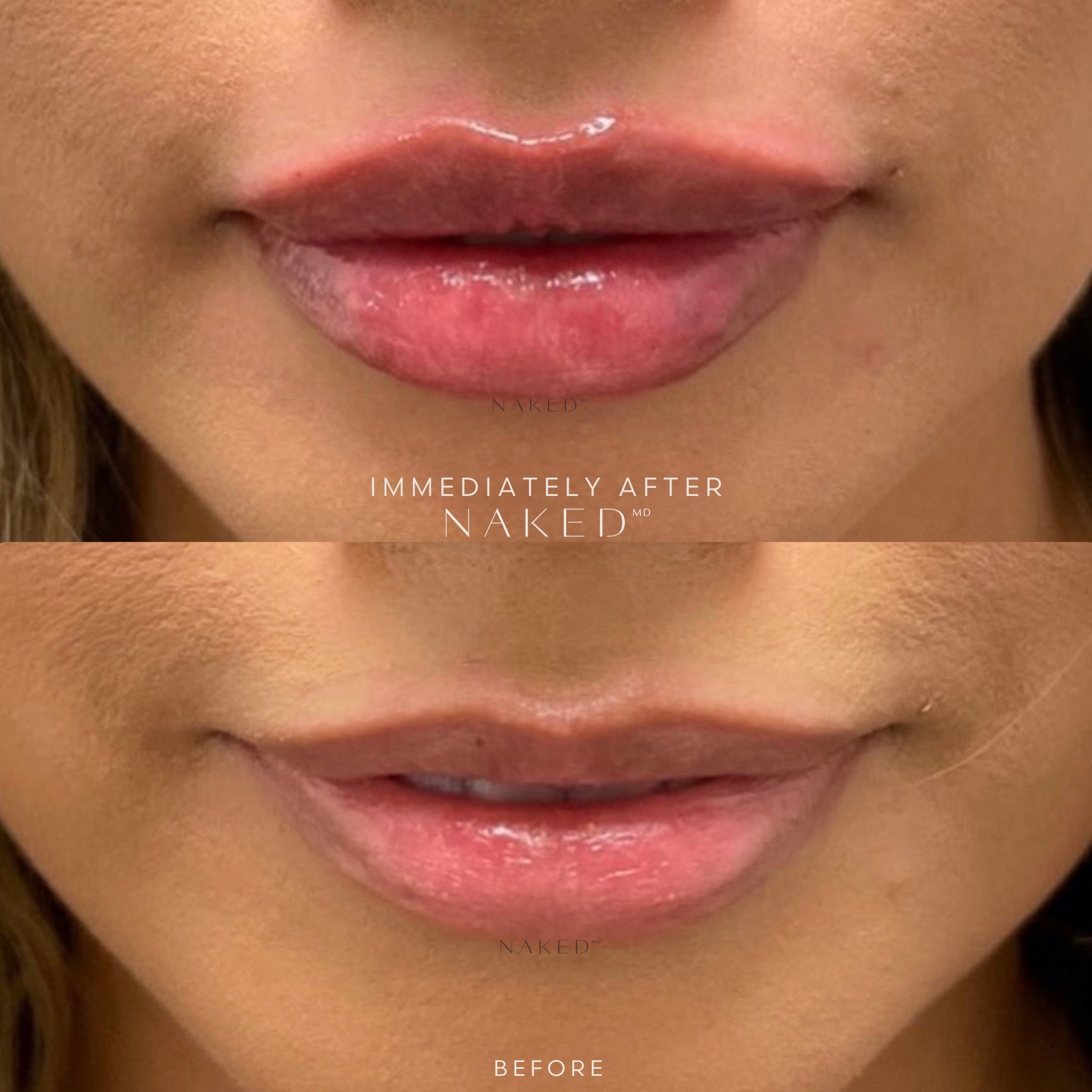 Naked Lips | Lip Filler