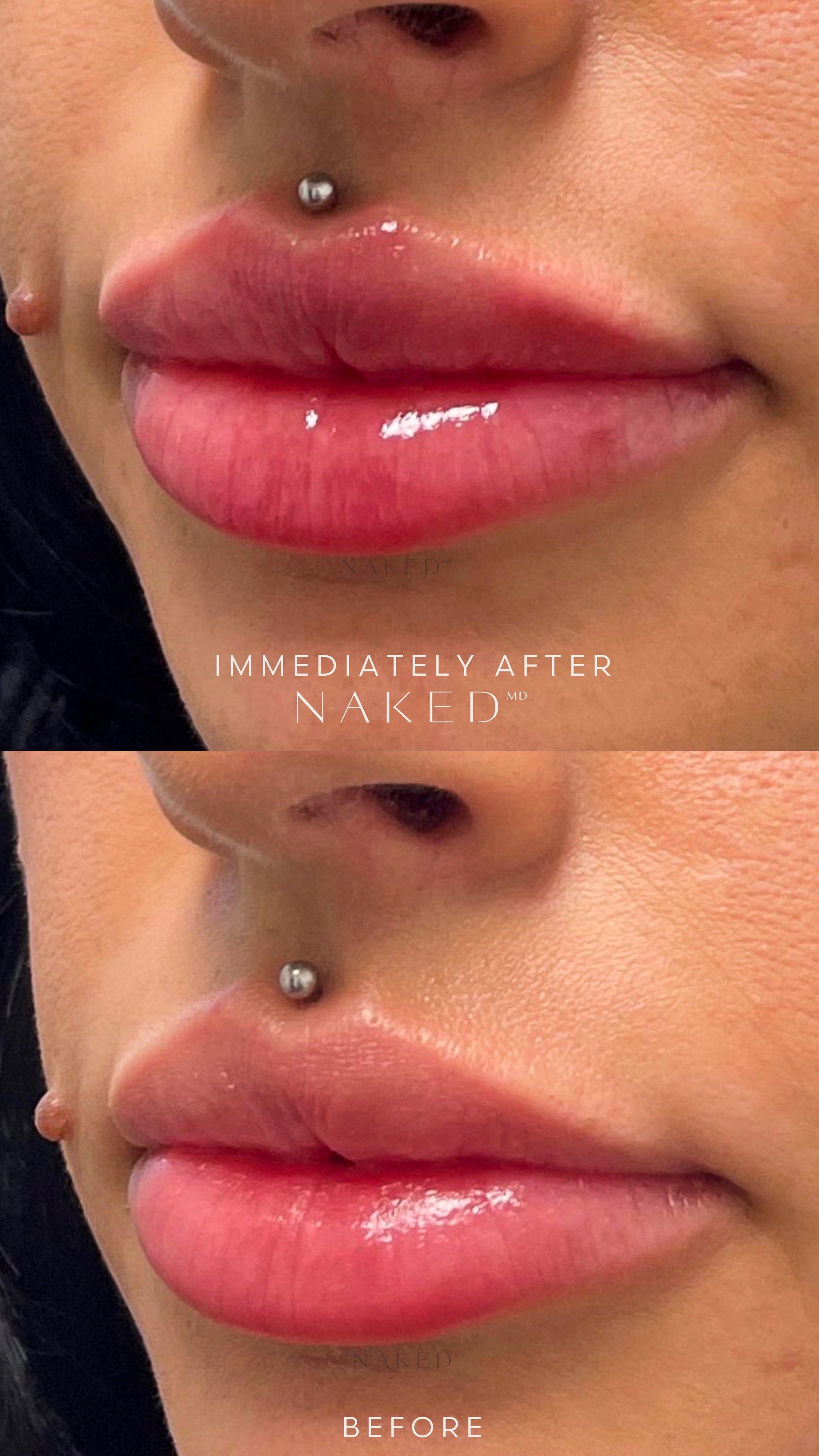 Naked Lips | Lip Filler