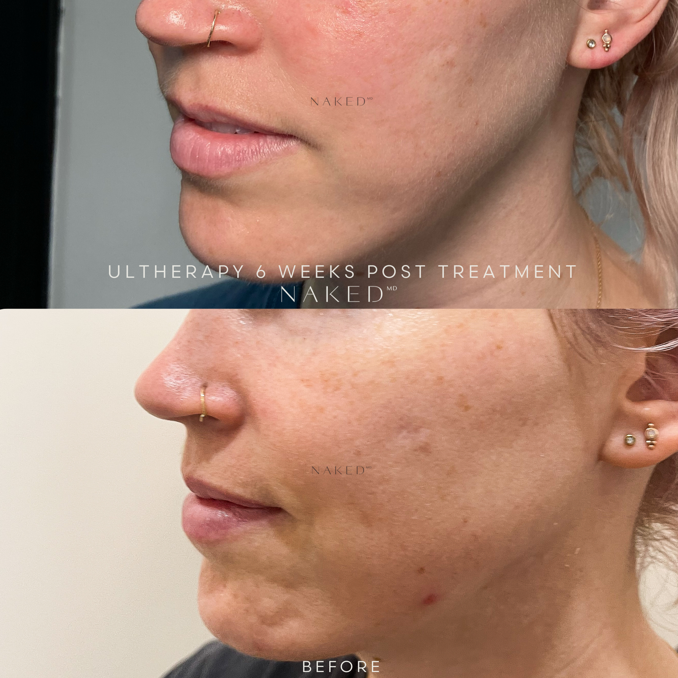 Ultherapy® Non Surgical Ultrasound Therapy