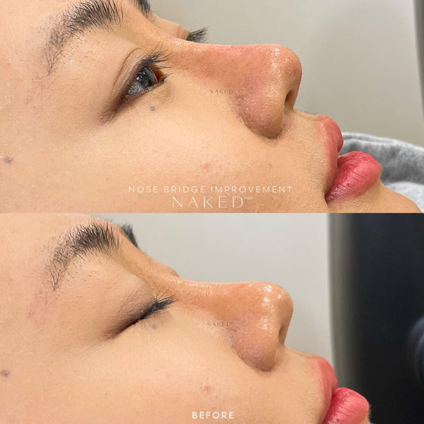 Naked Nose | Non-Surgical Nose Job (NSNJ)