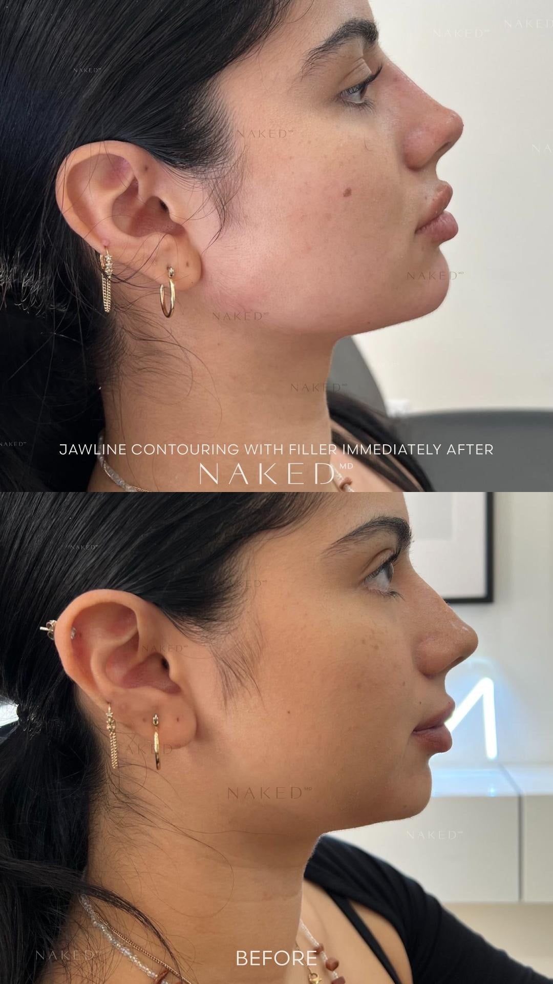 Contouring Dermal Jawline Dermal Fillers | Jawline Contouring in CA & AZ – NAKEDMD Medspa