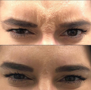 Naked TOX | Neurotoxins