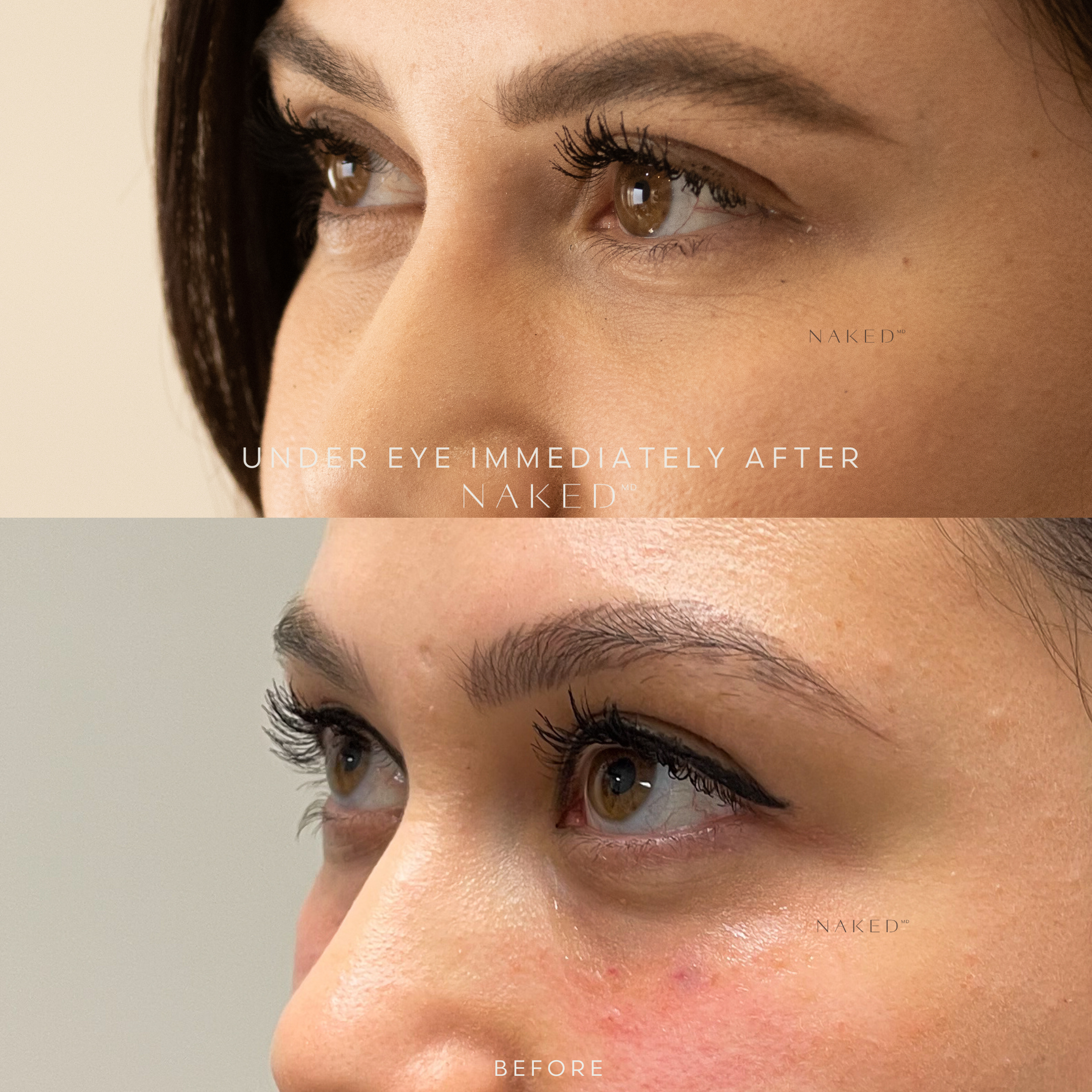 Undereye Filler | 1st Time Patient Promo