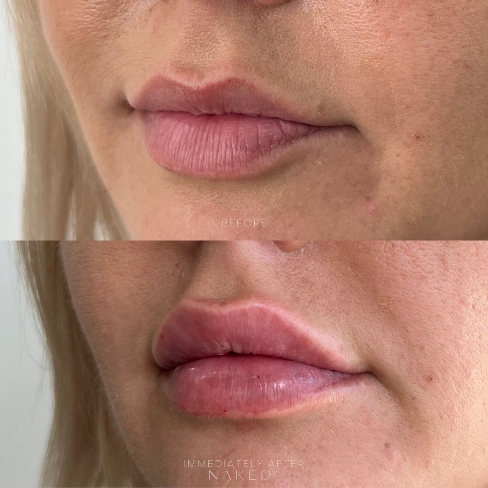 Naked Lips | Lip Filler