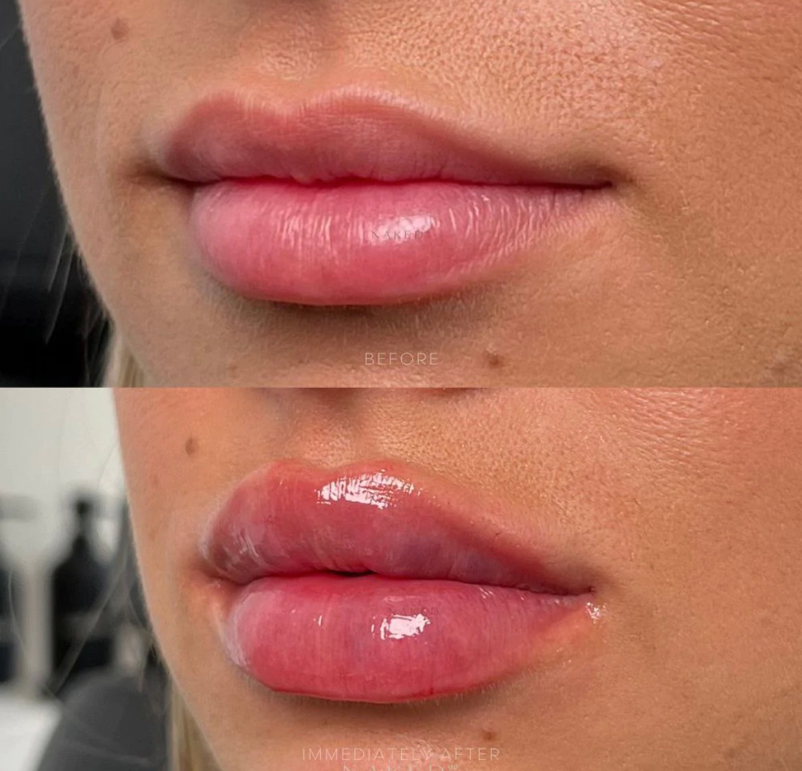 Naked Lips | Lip Filler