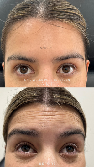 BOTOX® | Neurotoxins
