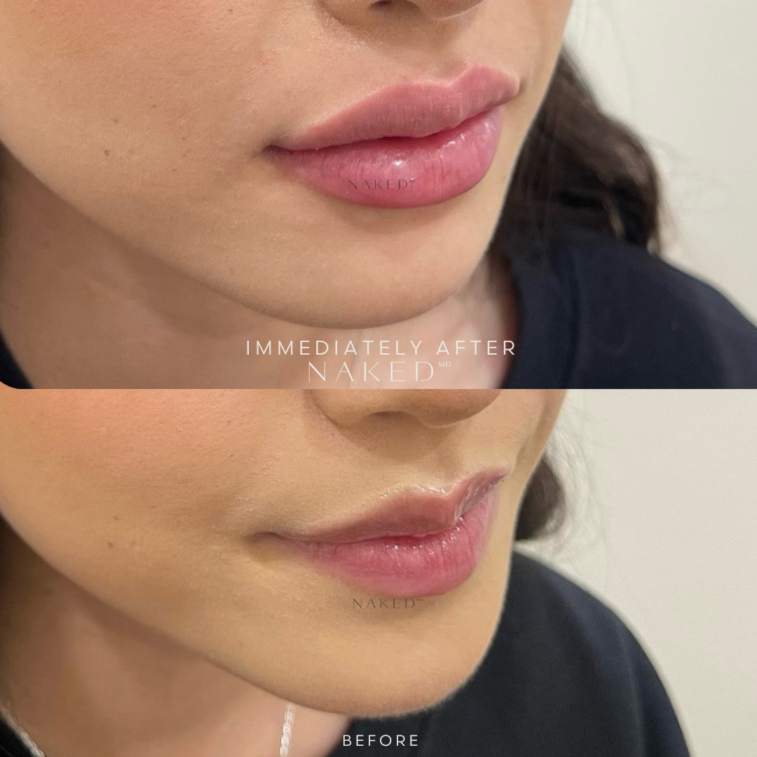 Naked Lips | Lip Filler