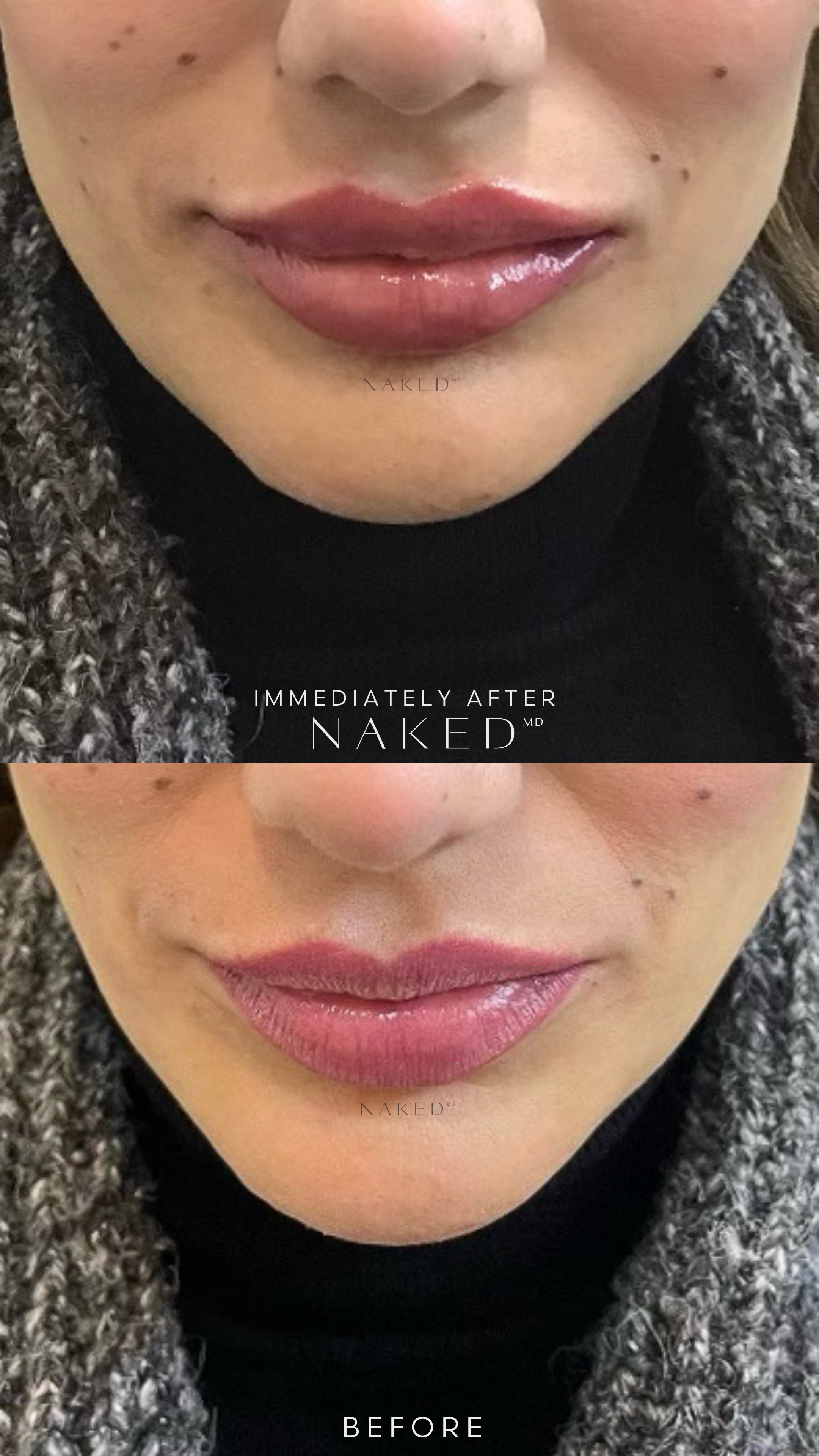 Naked Lips | Lip Filler