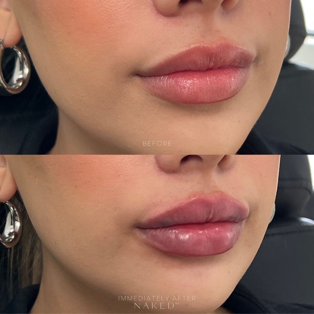 Lip Filler | 1st Time Patient Promo
