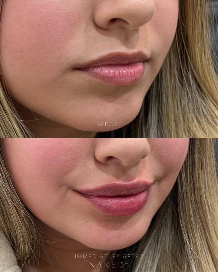 Naked Lips | Lip Filler