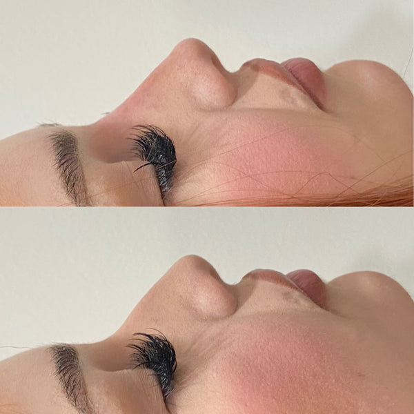 Naked Nose | Non-Surgical Nose Job (NSNJ)