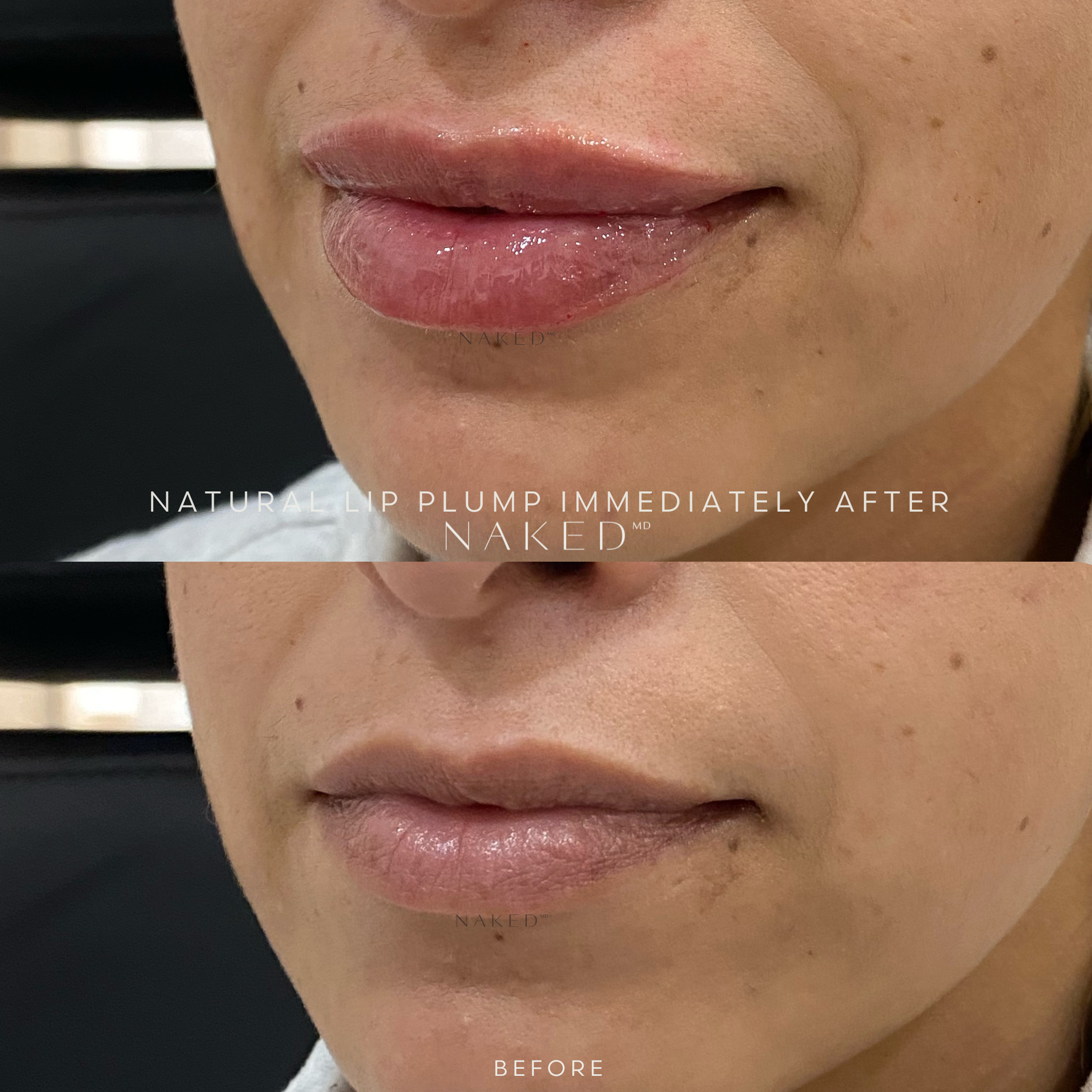 Naked Lips | Lip Filler