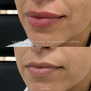 Naked Lips | Lip Filler