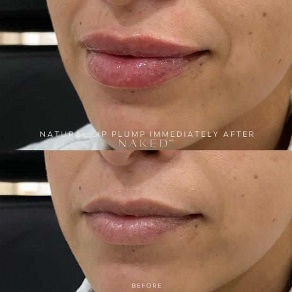 Naked Lips | Lip Filler