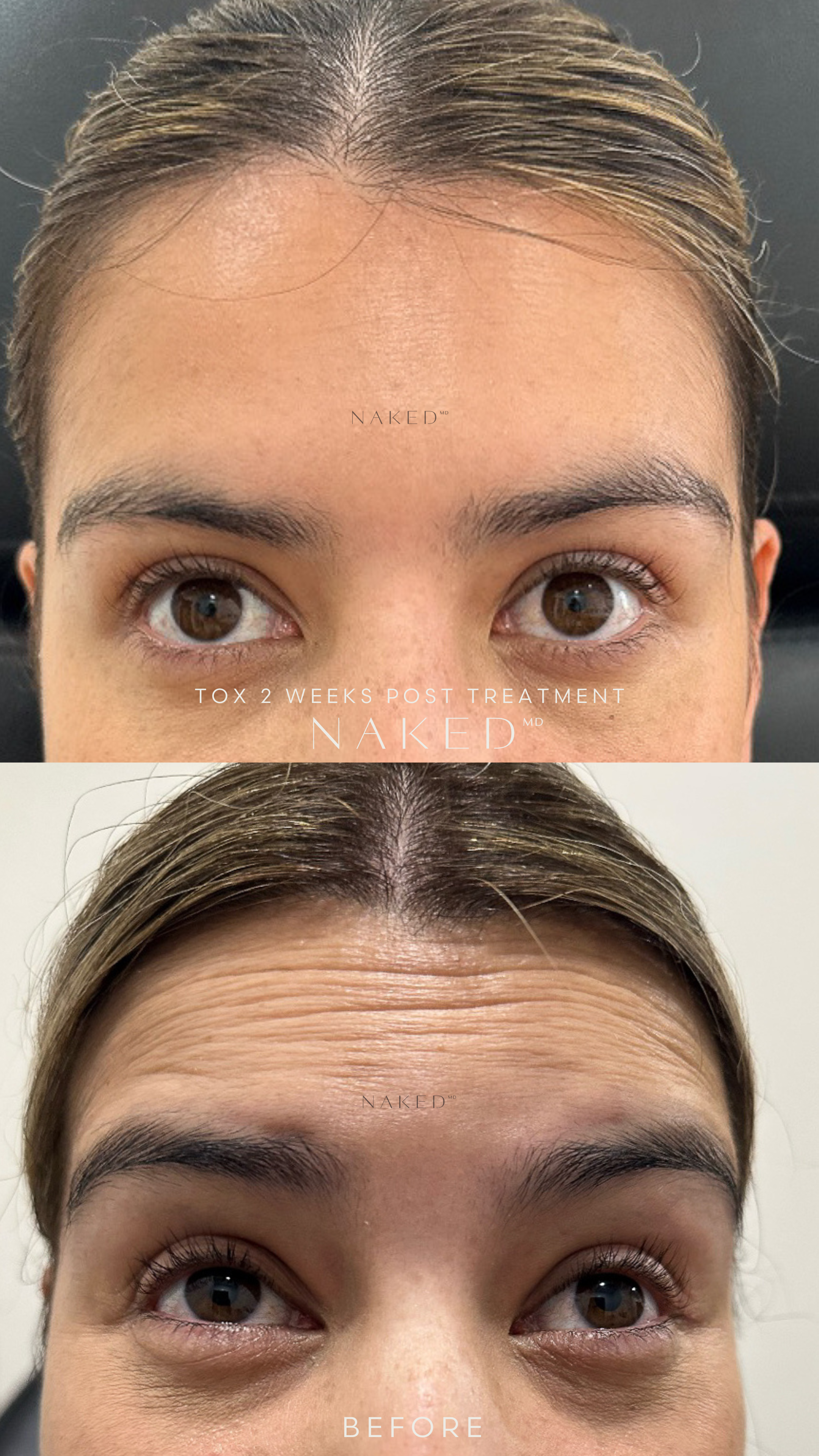 Forehead Neurotoxin | Tox Treatment