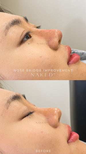 Naked Nose | Non-Surgical Nose Job (NSNJ)