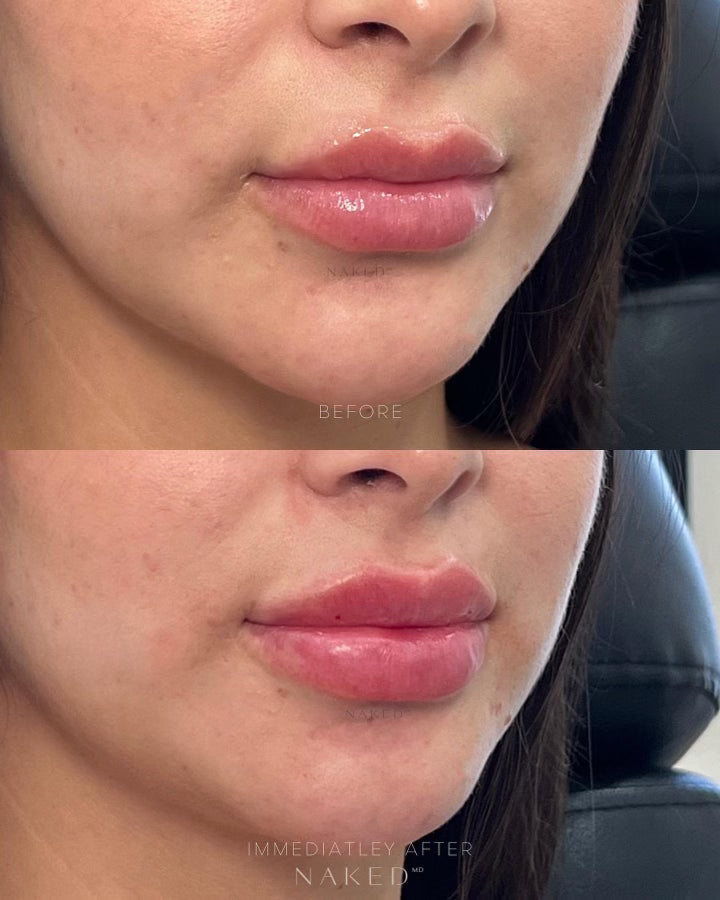 Naked Lips | Lip Filler