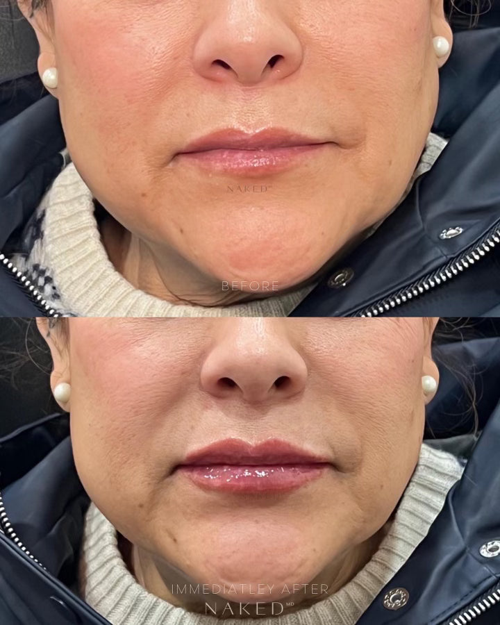 Lip Filler | 1st Time Patient Promo
