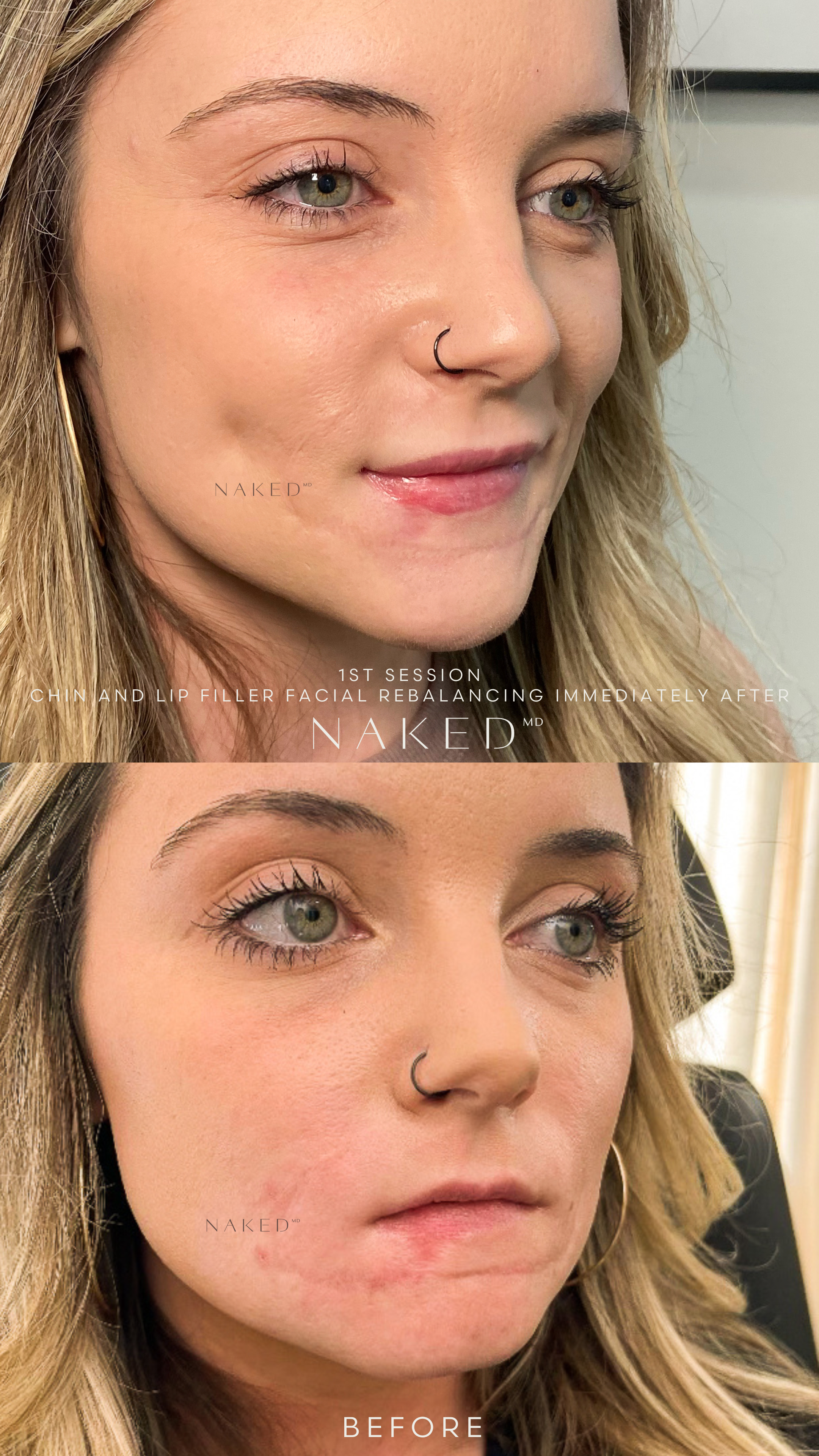 Naked Lips | Lip Filler