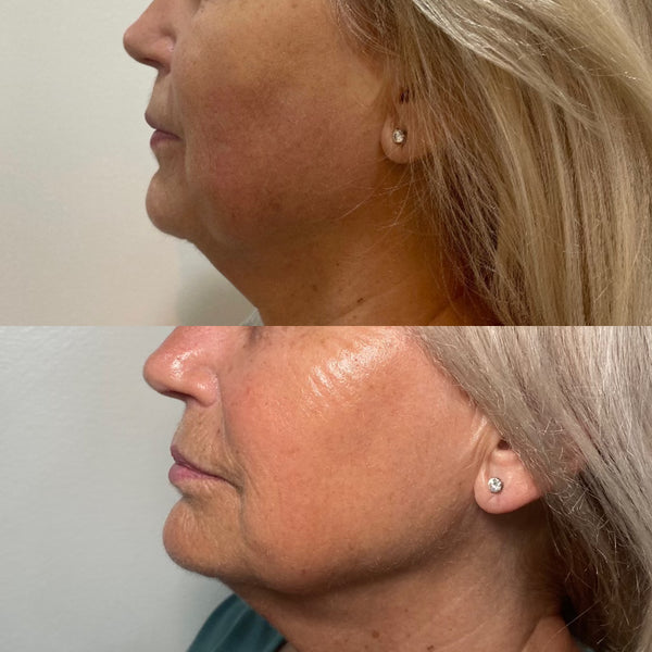 Ultherapy® | Non-Surgical Ultrasound Therapy