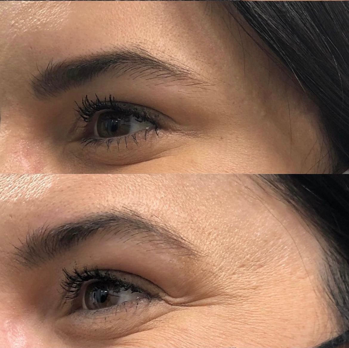 Crows Feet