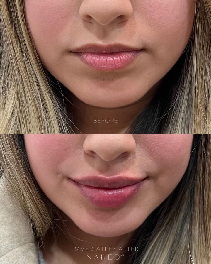 Naked Lips | Lip Filler