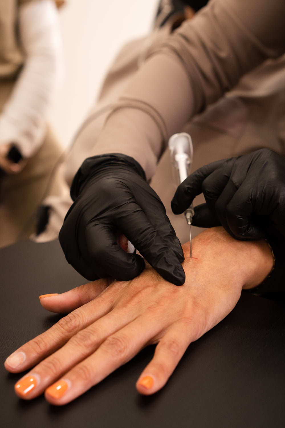 Hand Filler with Radiesse