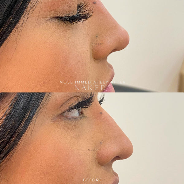 Naked Nose | Non-Surgical Nose Job (NSNJ)